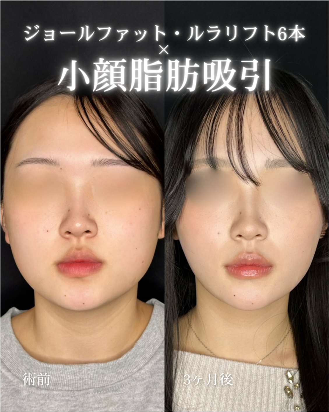 ルラ式クイック小顔脂肪吸引