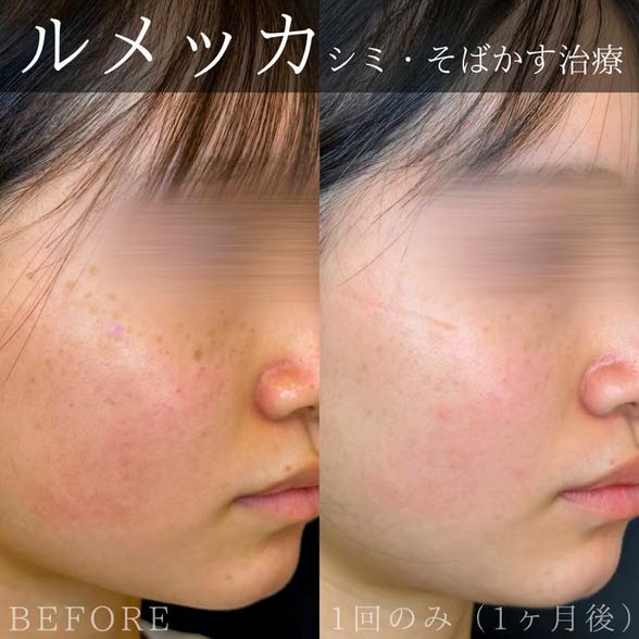 美容皮膚科症例写真