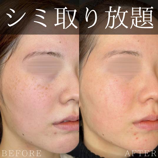 美容皮膚科症例写真
