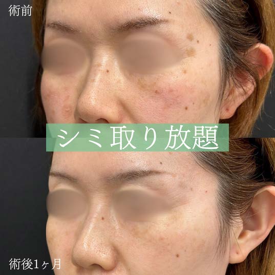美容皮膚科症例写真