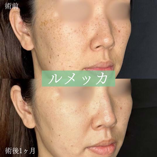 美容皮膚科症例写真