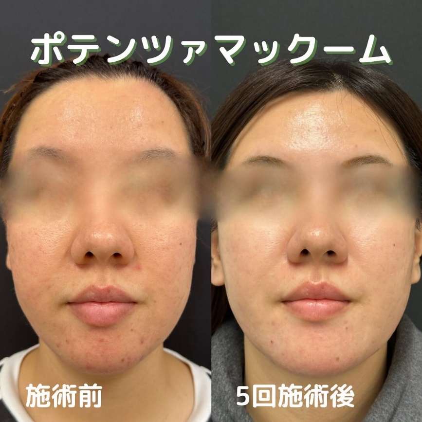 美容皮膚科症例写真