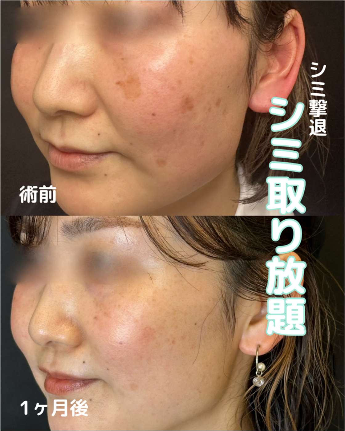 美容皮膚科症例写真