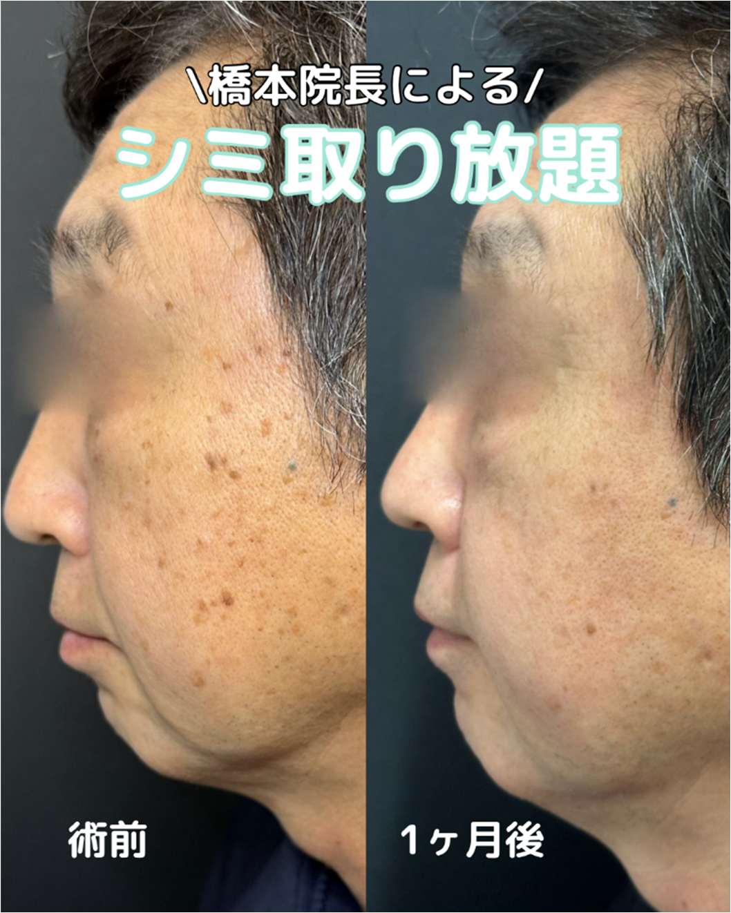 美容皮膚科症例写真