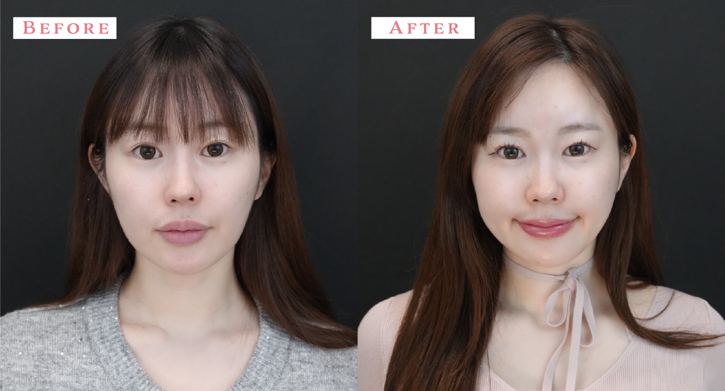 ドールチークの症例 before&after