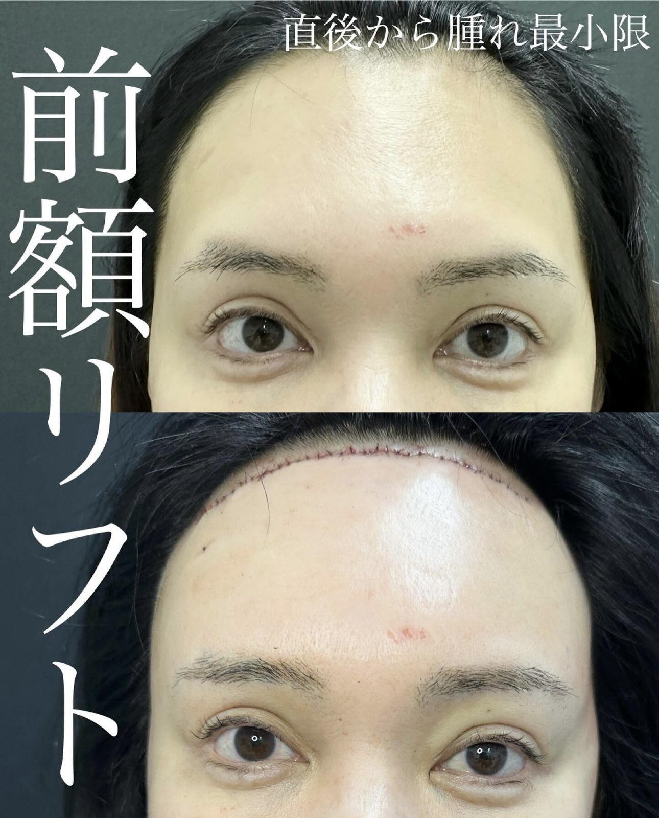 前額リフト手術の症例写真