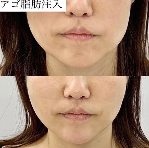 脂肪注入の症例写真