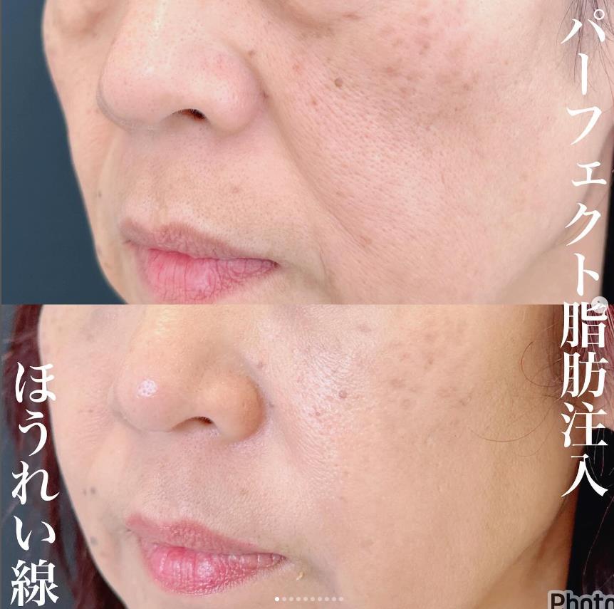 脂肪注入の症例写真