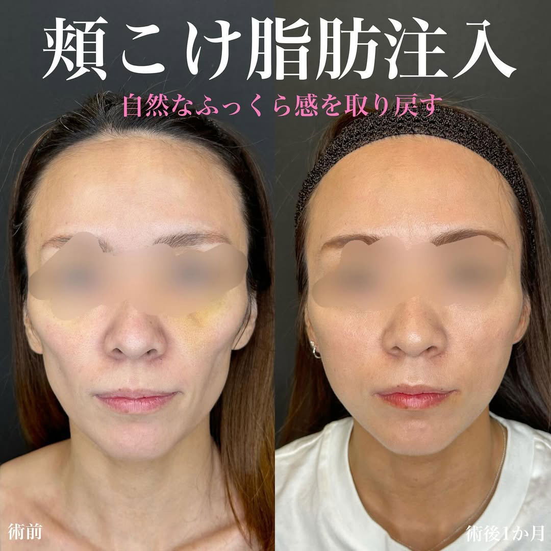 脂肪注入の症例写真
