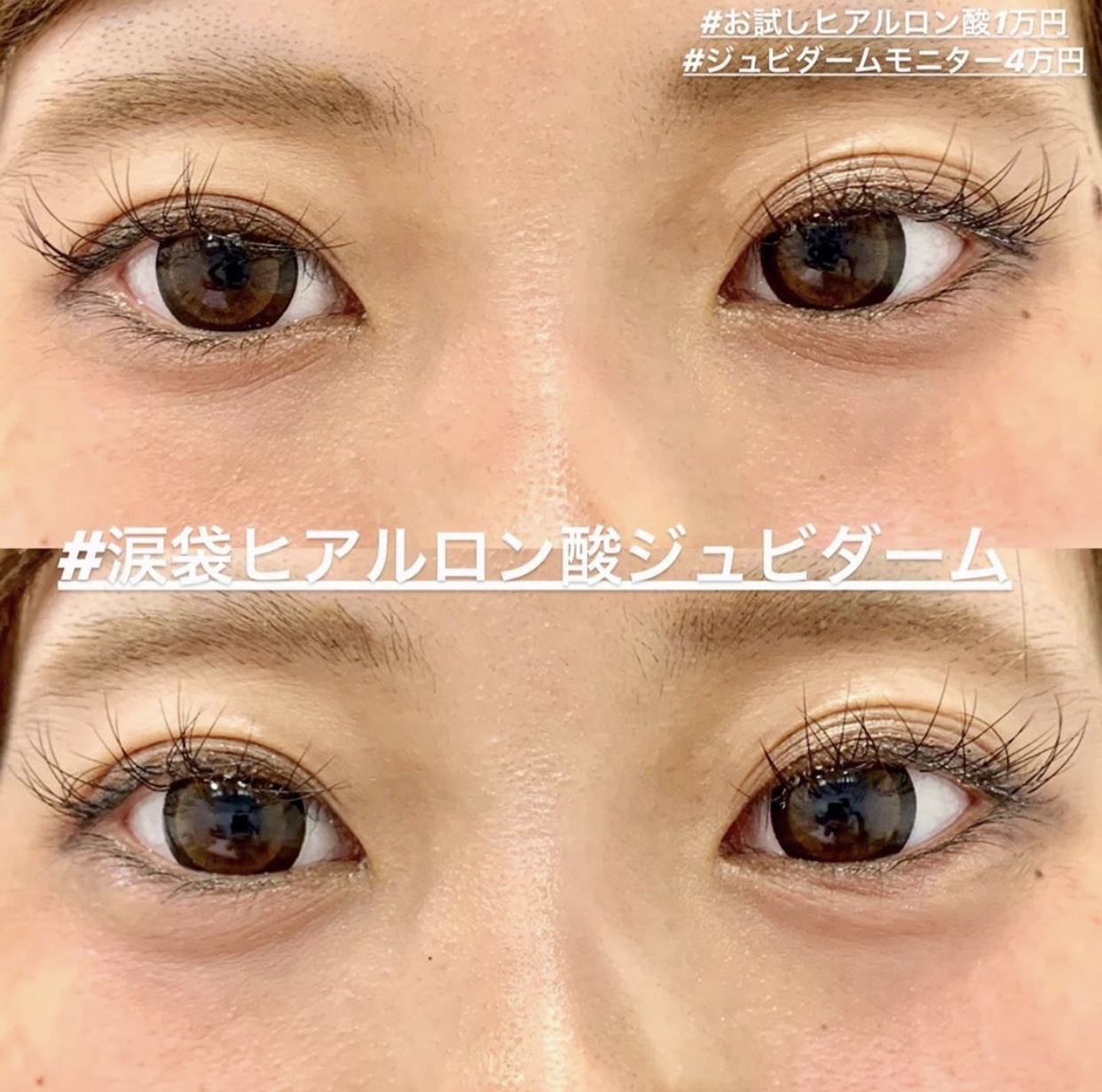 ヒアルロン酸注入の症例写真