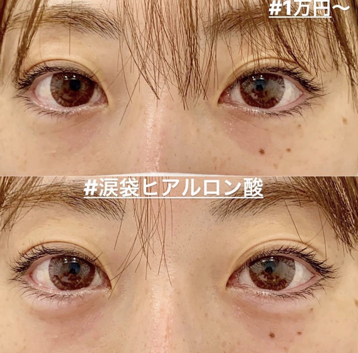 ヒアルロン酸注入の症例写真