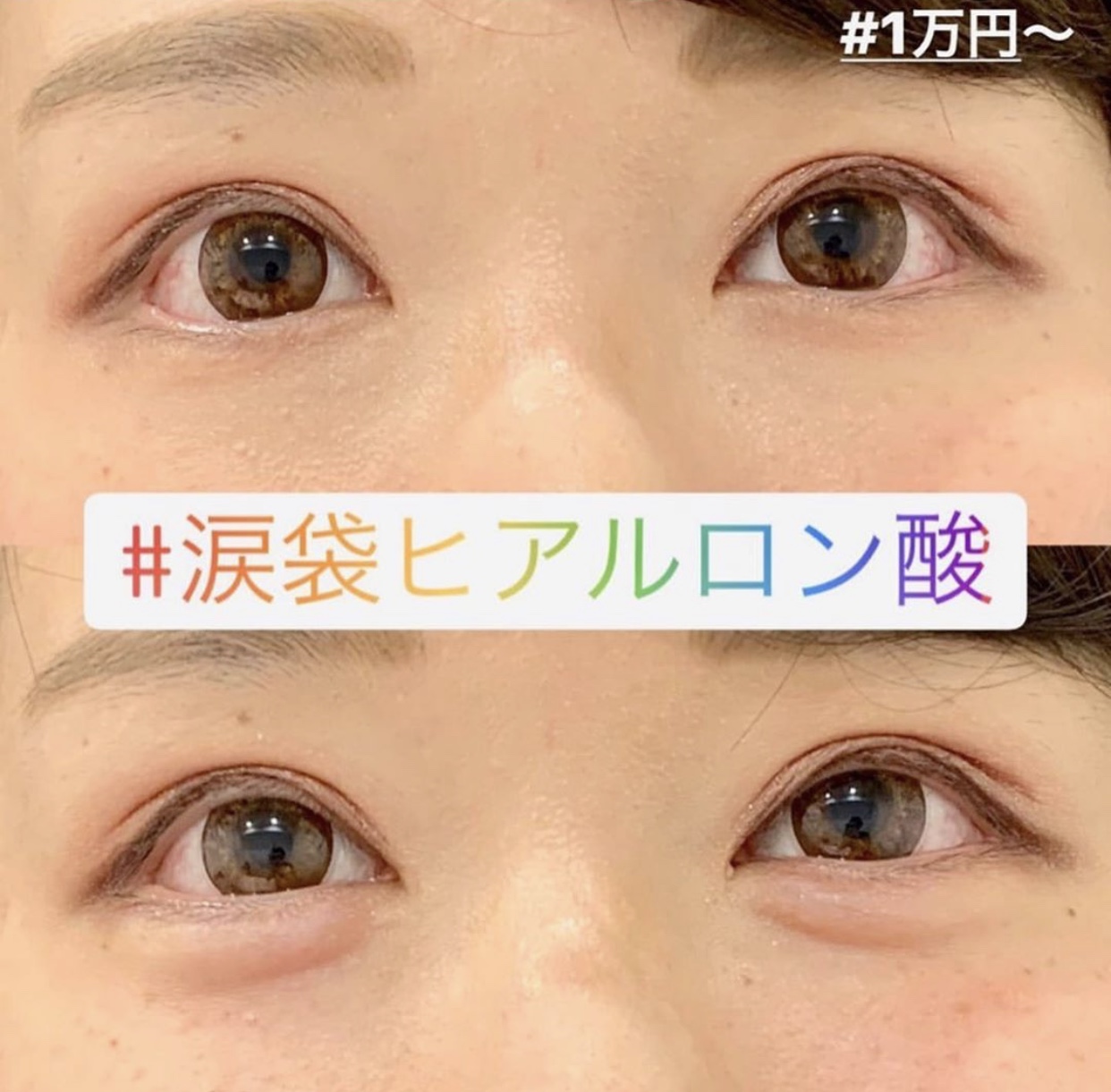 ヒアルロン酸注入の症例写真