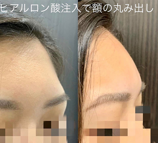 ヒアルロン酸注入の症例写真