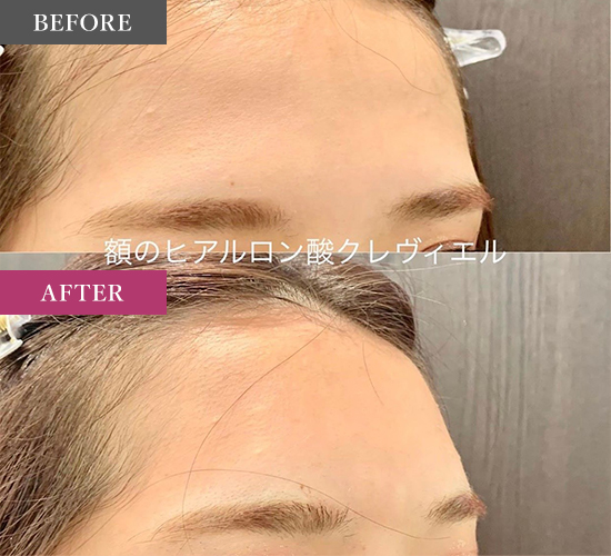 ヒアルロン酸注入の症例写真