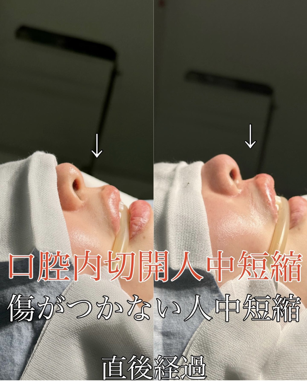 傷がつかない人中短縮の症例写真