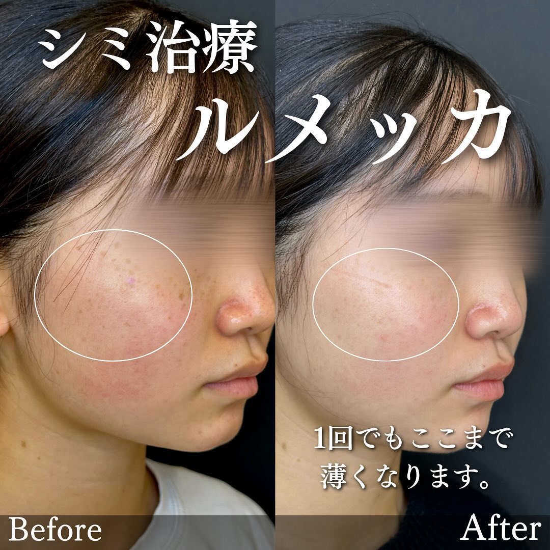 ルメッカの症例写真