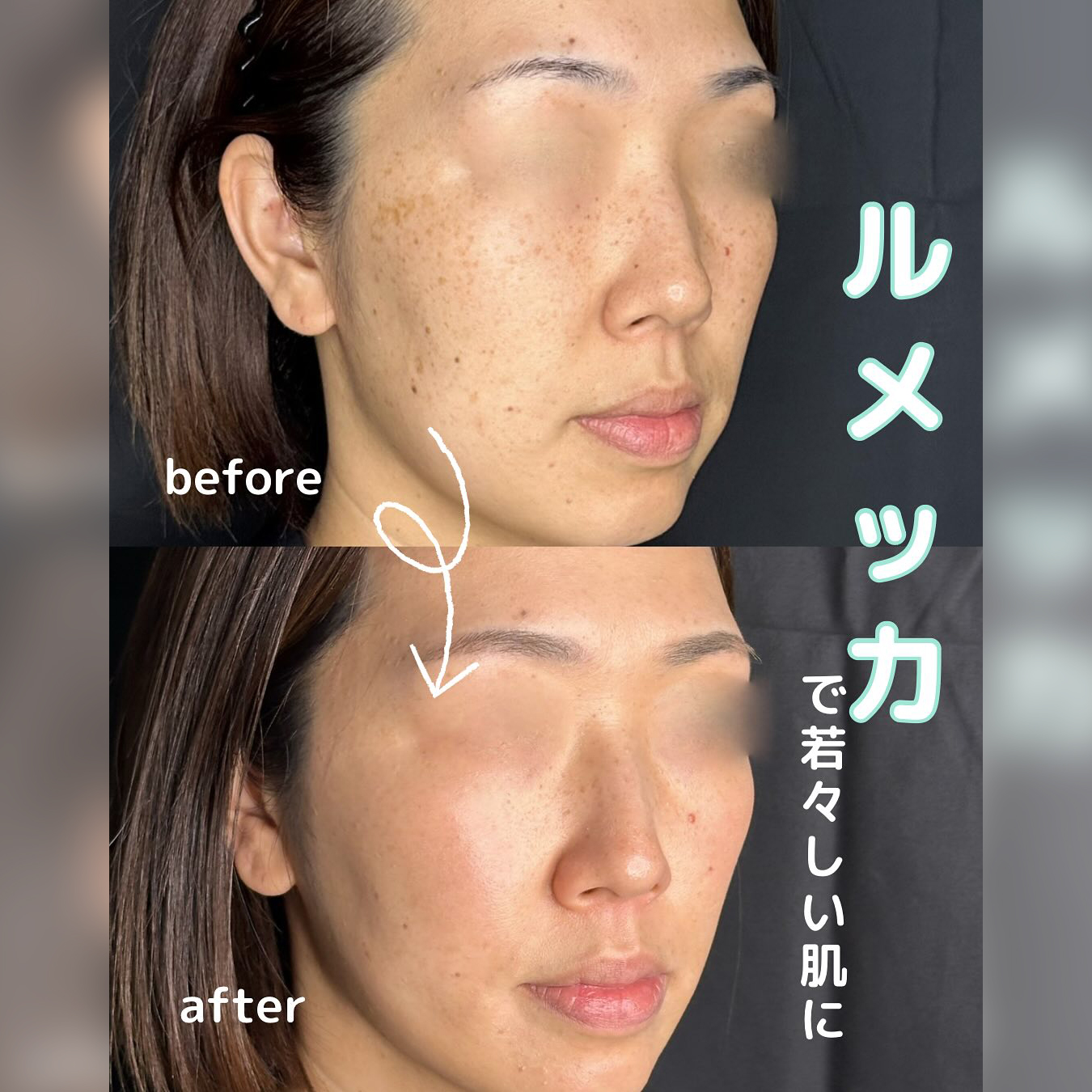 ルメッカの症例写真