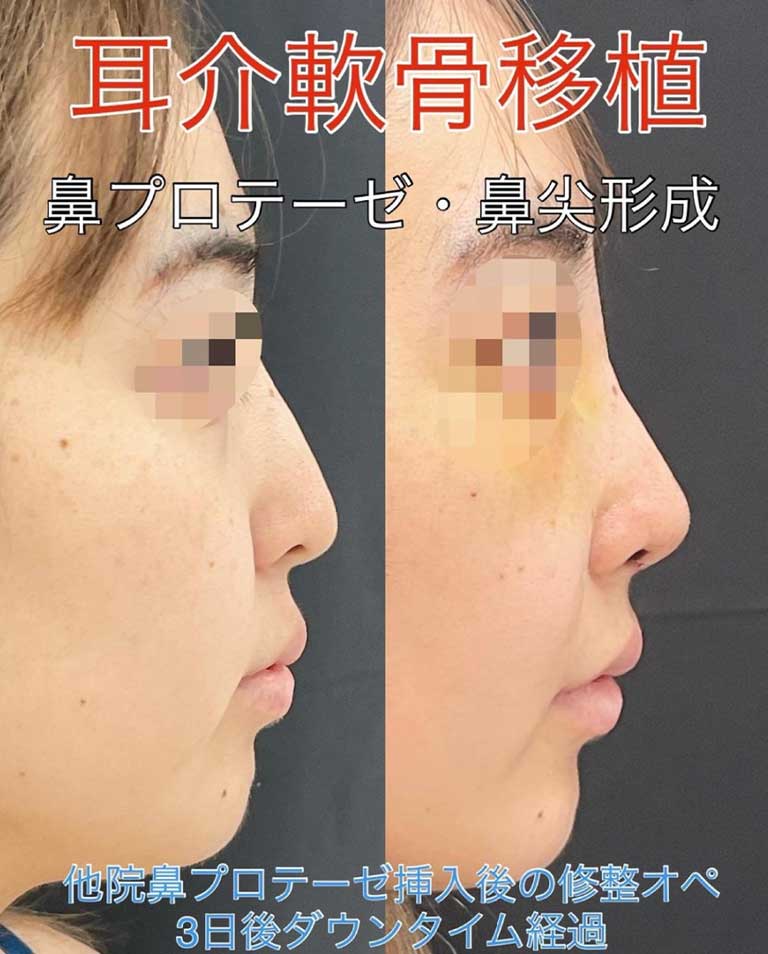 耳介軟骨移植