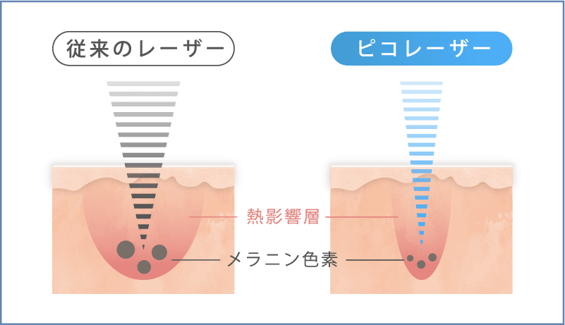レーザーの比較画像
