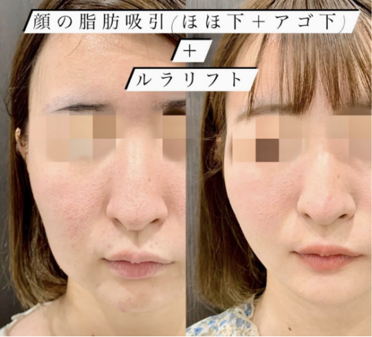 ほほ下＋あご下脂肪吸引