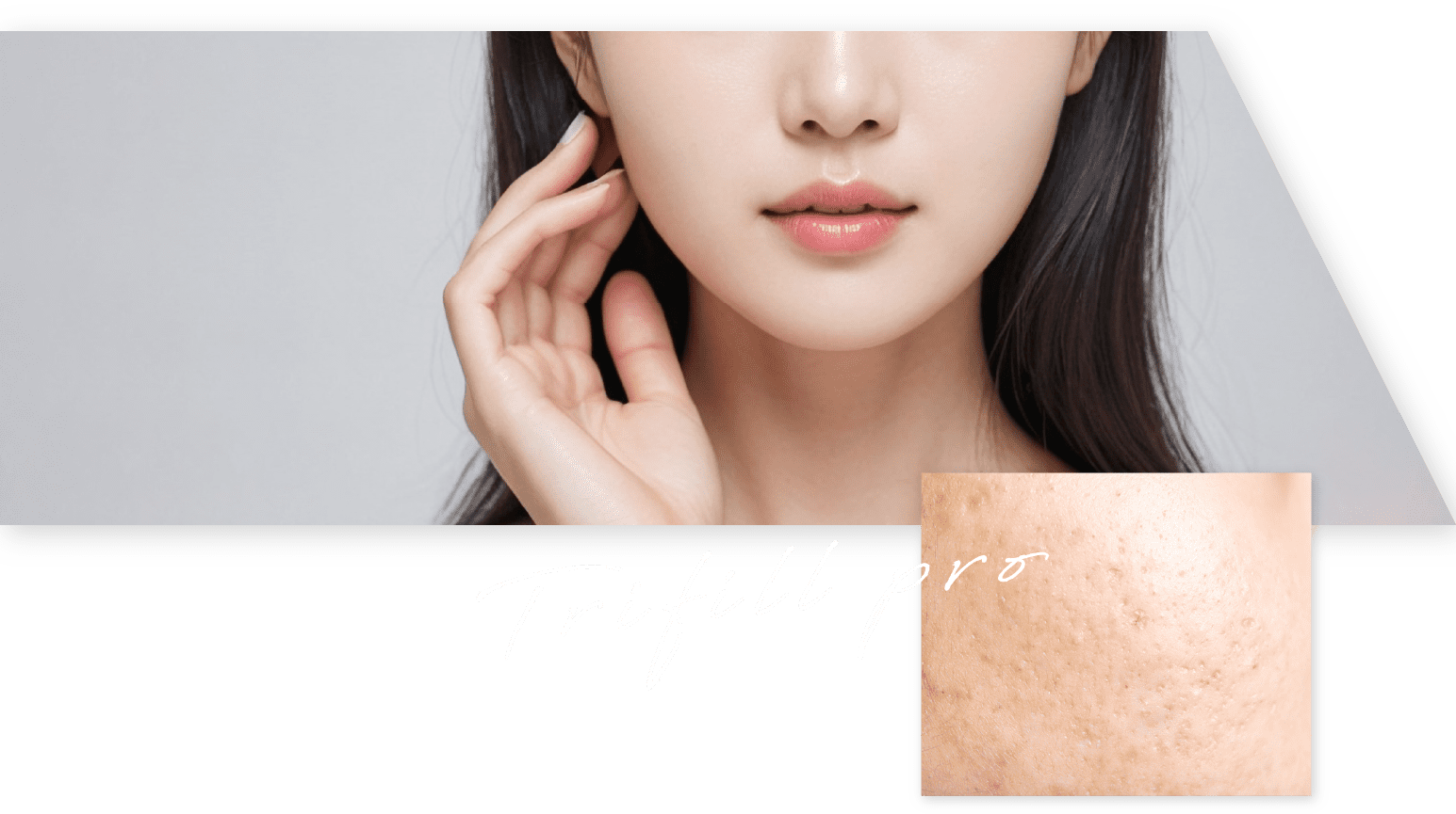 Trifill pre