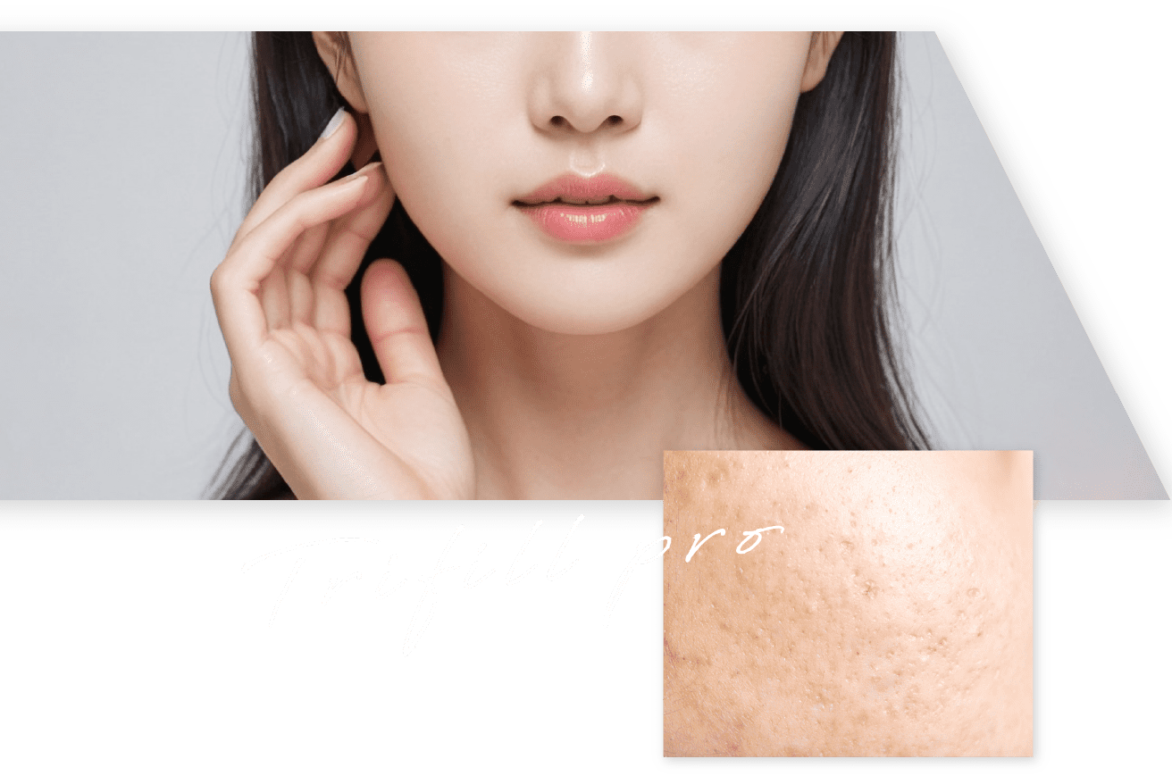 Trifill pre
